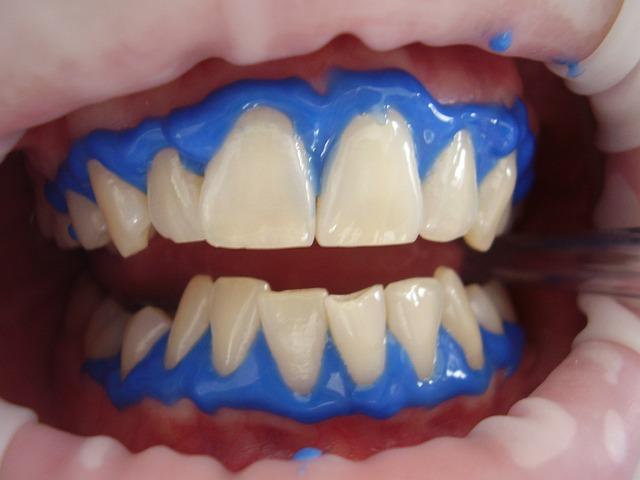 Bělení zubů laserem: Dlouhotrvající výsledky a péče po proceduře