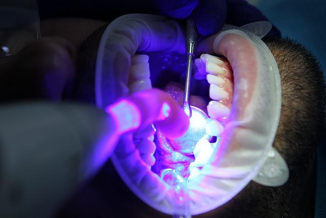 Bělení zubů doma versus profesionální bělení zubů:⁤ co je lepší volba?