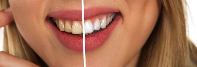 Jaký je nejlepší způsob, jak dosáhnout bílých zubů